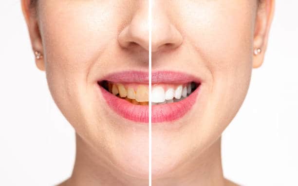 Teeth Whitening Milton Keynes Leicestershire