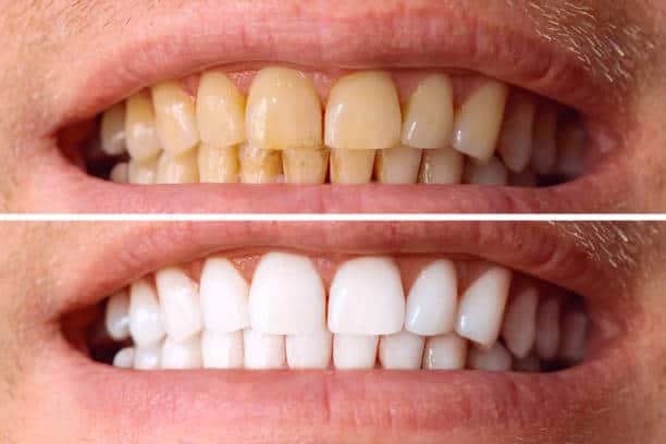 Laser White For Ever Bright – Get a Brighter, Whiter Smile with LA Teeth Whitening Leicestershire