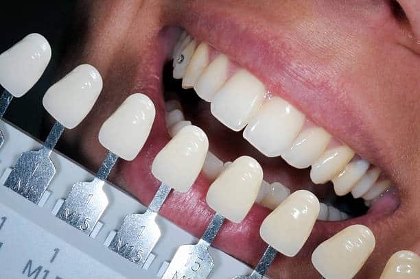 Get Natural and Stunning Smile with Teeth Whitening Results from LA Teeth Whitening Leicestershire