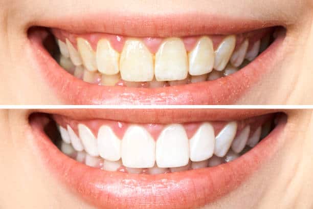 Achieve a Dazzling Smile for Your Special Day: A Guide to Wedding Teeth Whitening Leicestershire