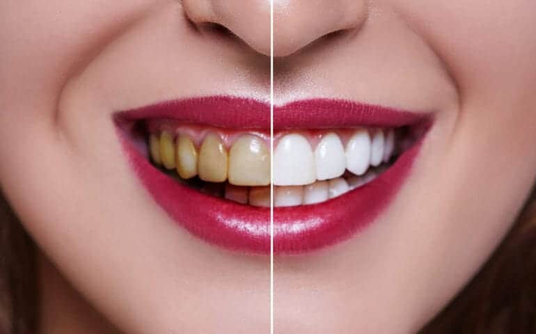 Teeth Whitening Ascot Windsor Leicestershire