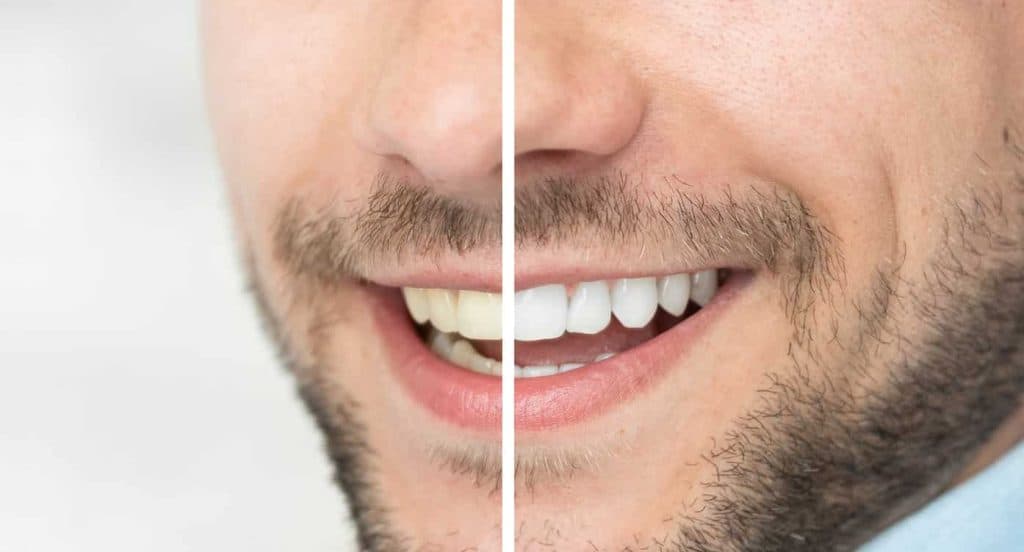 Teeth Whitening Bedfordshire Leicestershire