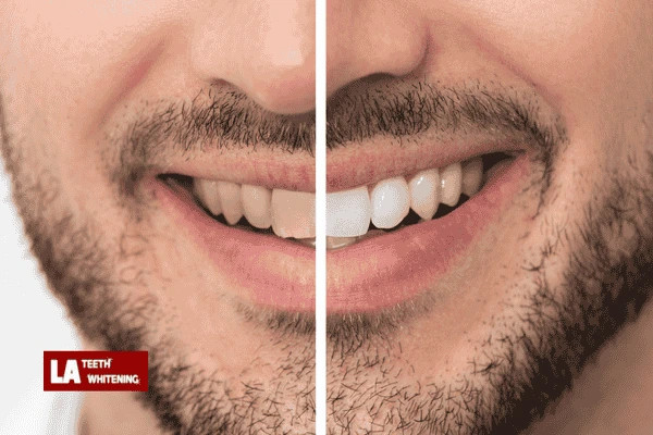 Concerned over the side effects of laser teeth whitening? Leicestershire